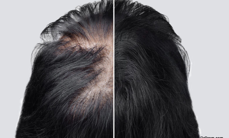 Women Get A Hair Transplant